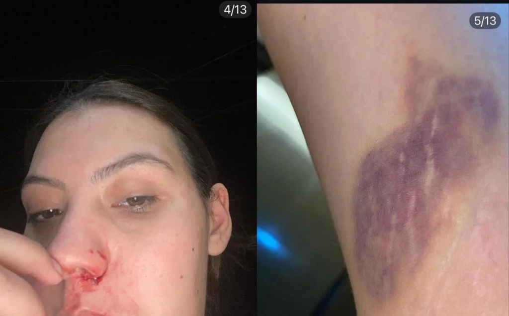 Un estudiante de la Upaep golpeó brutalmente a su novia .