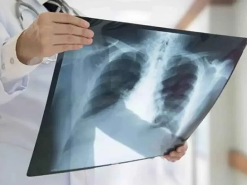 Día Mundial de la Tuberculosis: una de las enfermedades más letales  
