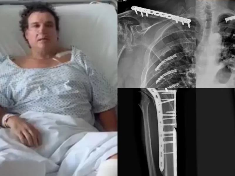 Pluma de seguridad provoca múltiples fracturas a residente de Lomas de Angelópolis; GEIC no responde