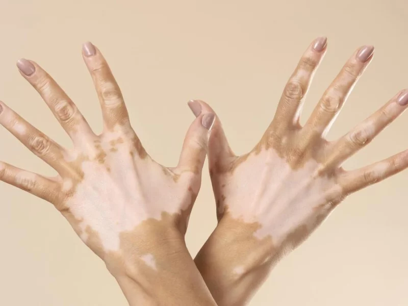 ¿Por qué se conmemora el Día Mundial del Vitiligo? 