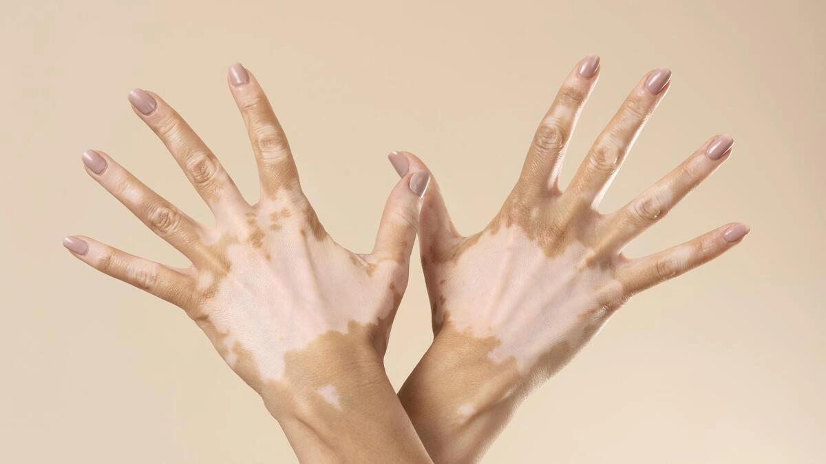 ¿Por qué se conmemora el Día Mundial del Vitiligo? 