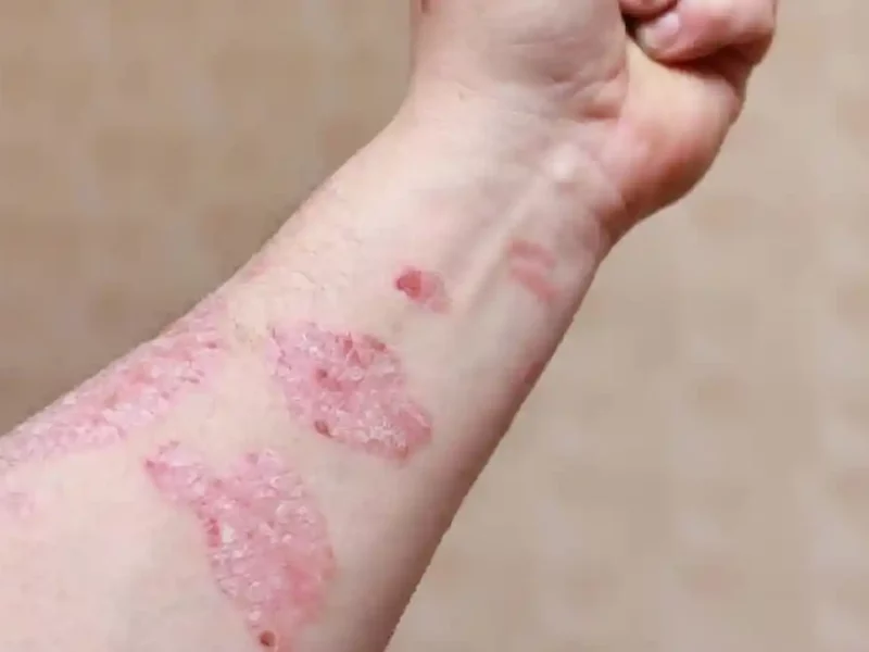 Psoriasis en el antebrazo de un hombre.
